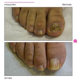 FOOT AND NAIL CARE - Before and After