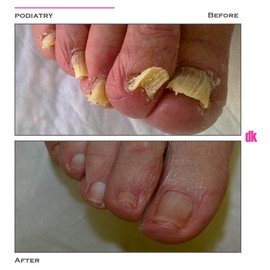 FOOT AND NAIL CARE - Before and After