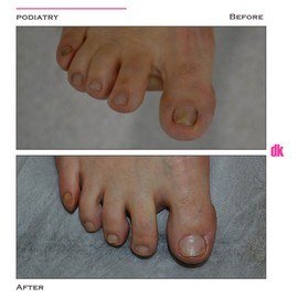 FOOT AND NAIL CARE - Before and After