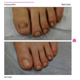 FOOT AND NAIL CARE - Before and After