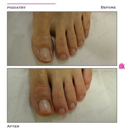 FOOT AND NAIL CARE - Before and After