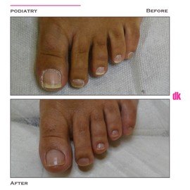 FOOT AND NAIL CARE - Before and After
