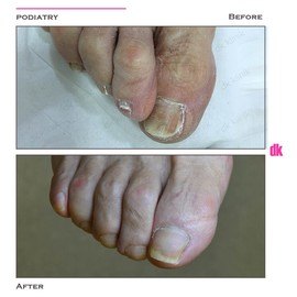 FOOT AND NAIL CARE - Before and After