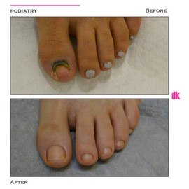 FOOT AND NAIL CARE - Before and After