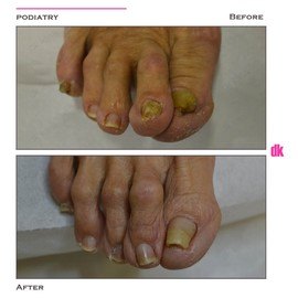 FOOT AND NAIL CARE - Before and After