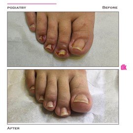 FOOT AND NAIL CARE - Before and After