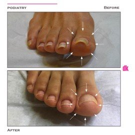 FOOT AND NAIL CARE - Before and After