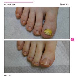 FOOT AND NAIL CARE - Before and After