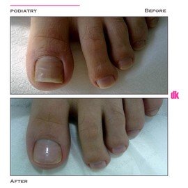 FOOT AND NAIL CARE - Before and After