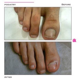 FOOT AND NAIL CARE - Before and After