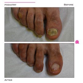 FOOT AND NAIL CARE - Before and After