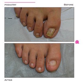 FOOT AND NAIL CARE - Before and After