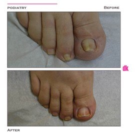 FOOT AND NAIL CARE - Before and After