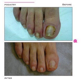 FOOT AND NAIL CARE - Before and After