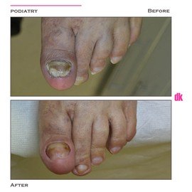 FOOT AND NAIL CARE - Before and After