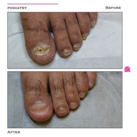 FOOT AND NAIL CARE - Before and After
