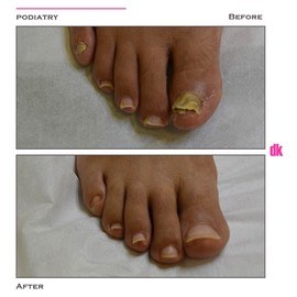 FOOT AND NAIL CARE - Before and After