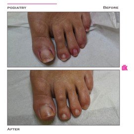 FOOT AND NAIL CARE - Before and After