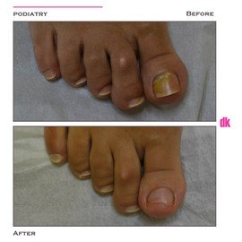 FOOT AND NAIL CARE - Before and After