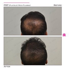HAIR LOSS TREATMENT - Before and After