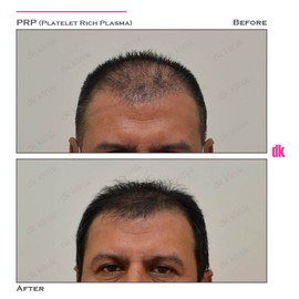 HAIR LOSS TREATMENT - Before and After