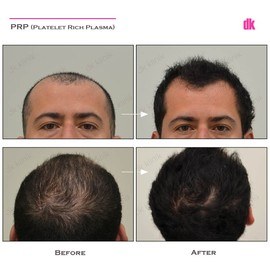 HAIR LOSS TREATMENT - Before and After
