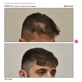 HAIR LOSS TREATMENT - Before and After