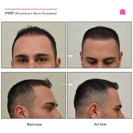 HAIR LOSS TREATMENT - Before and After