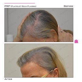HAIR LOSS TREATMENT - Before and After