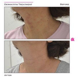 DERMATOLOGICAL ILLNESS TREATMENTS - Before and After