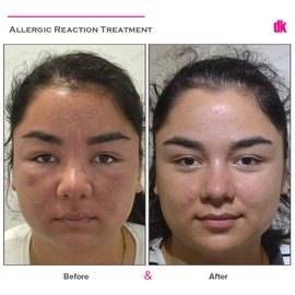 DERMATOLOGICAL ILLNESS TREATMENTS - Before and After