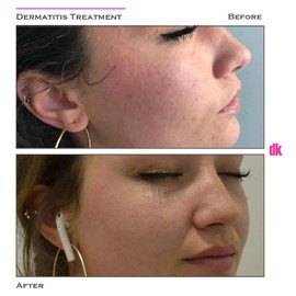 DERMATOLOGICAL ILLNESS TREATMENTS - Before and After