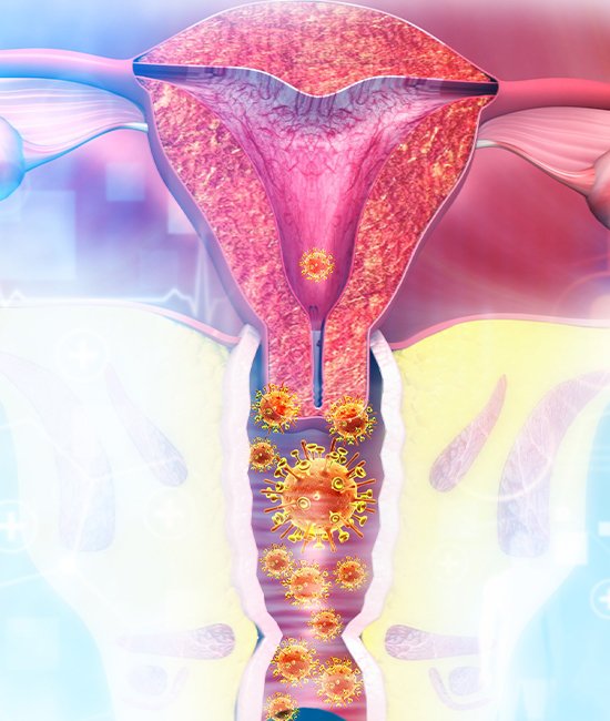 The Place of Laser Applications in Persistent Vaginal Fungal Infection