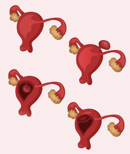 Myoma Treatment Antalya