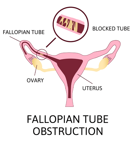 HYSTEROSALPINGOGRAPHY