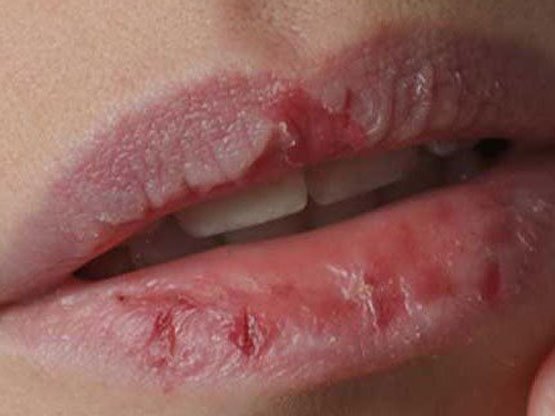 Kış Aylarında Cilt Bakımı Nasıl Yapılır Ankar