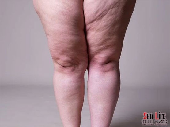 Lipödem Rahatsızlıklarında Ankara Lenf Drenaj Masajı