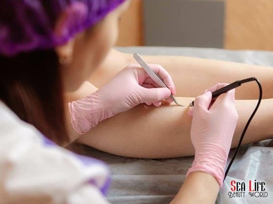 Igneli-Epilasyon-Ankara-Kizilay-Merkez