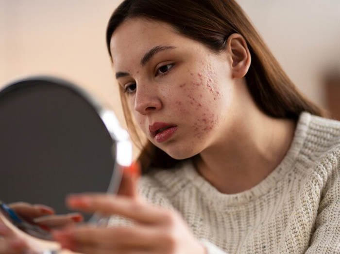 akne sivilce bakımı 2 büyük sayfa içi