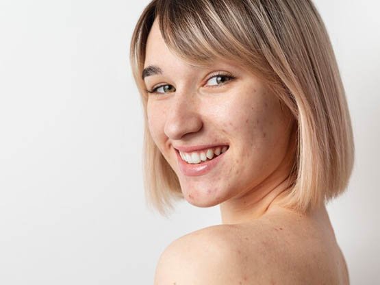 akne sivilce bakımı 3 yandaki