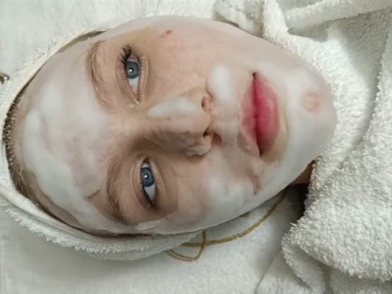 akne sivilce bakımı 4 yandaki