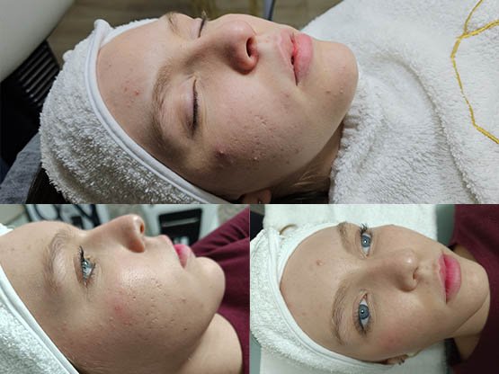 akne sivilce bakımı 5 yandaki