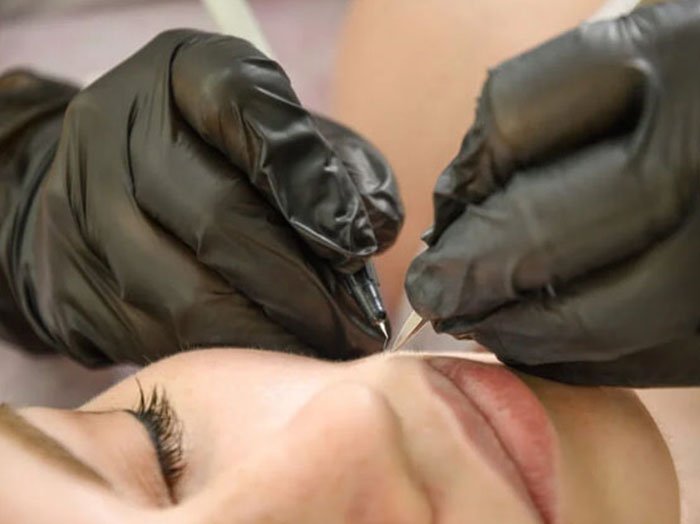 İğneli Epilasyon Ankara