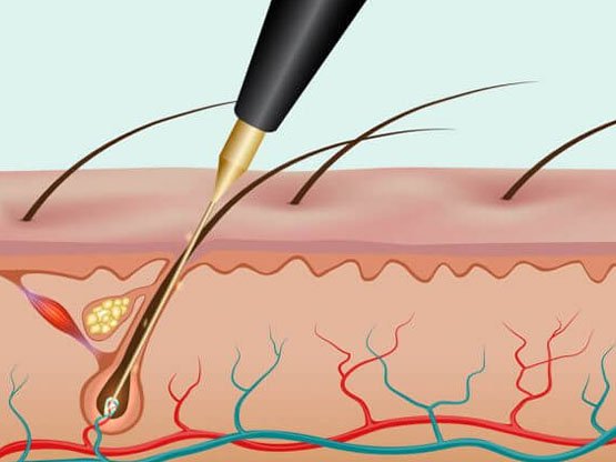 İğneli epilasyon nedir Ankara'da iğneli epilasyon