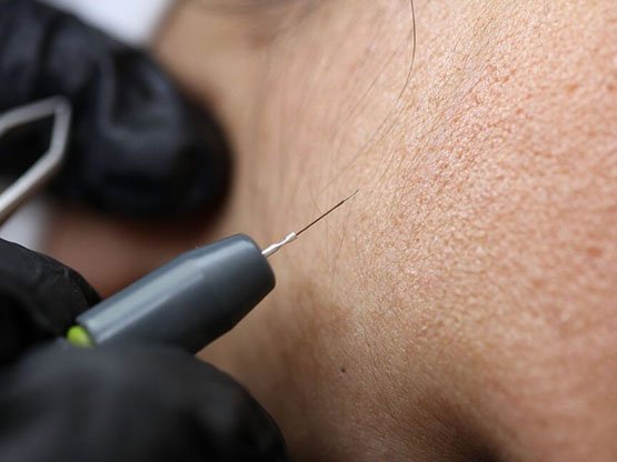 İğneli epilasyon nasıl yapılır