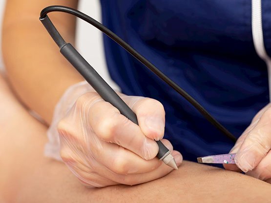 Ankara'da iğneli epilasyon nerede yaptırılır