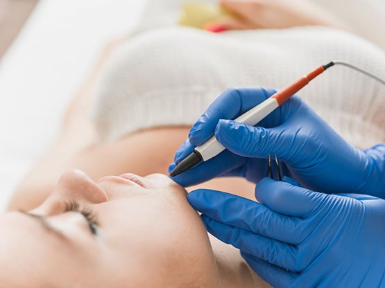 Ankara iğneli epilasyon tavsiye