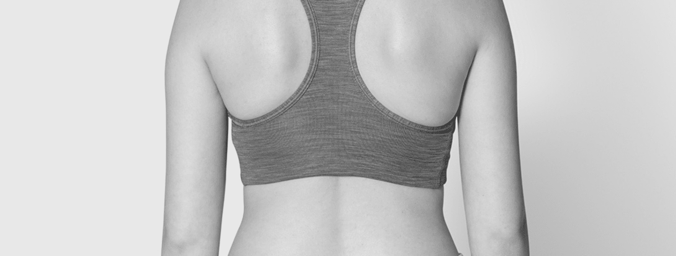 Sırt germe ameliyatı (back lift) sonrası elde edilen pürüzsüz, sıkı ve katlantısız sırt görünümü.