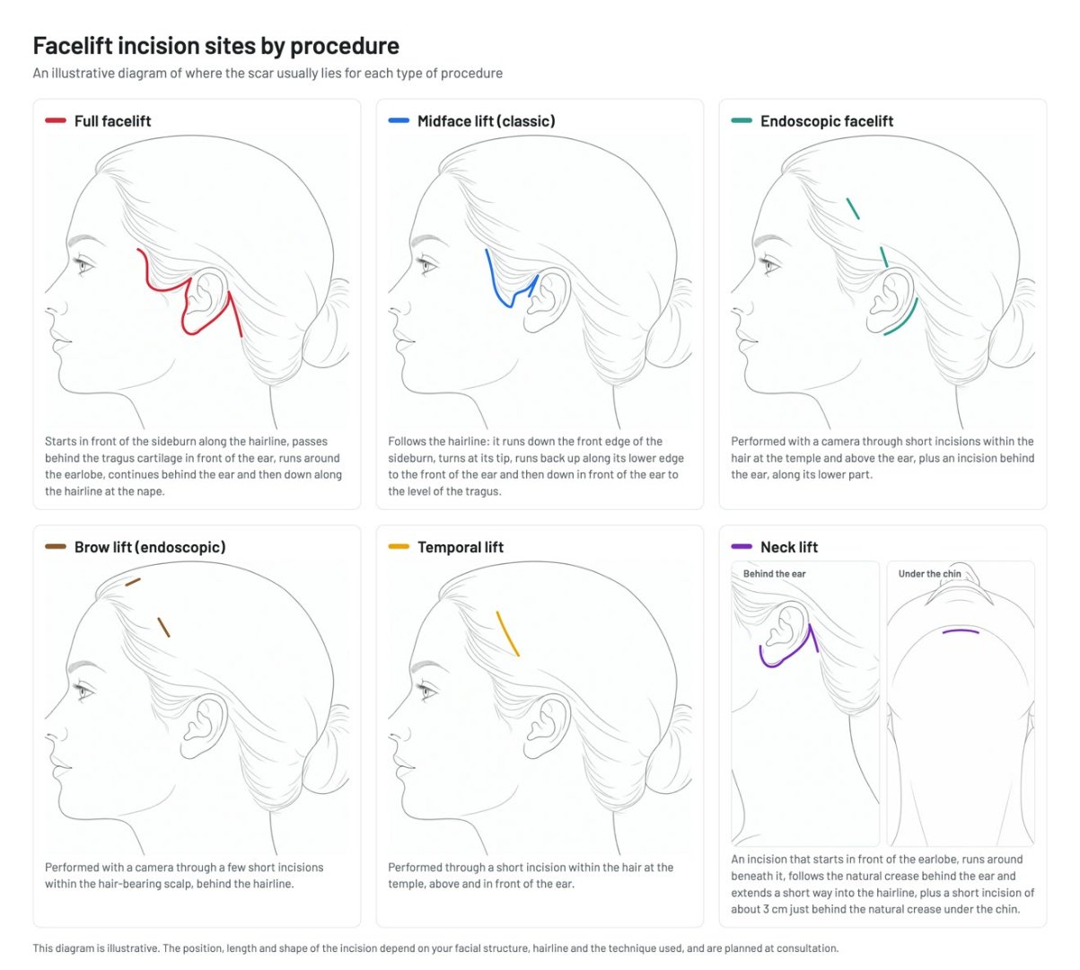 Incision sites in facelift surgery: illustrative diagram for full facelift, classic mid-face lift, endoscopic facelift, endoscopic brow lift, temporal lift and neck lift