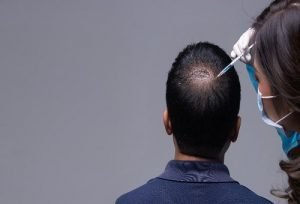 sac-mezoterapisi-2-300x204